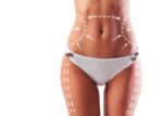 01. abdominoplastia o lipoescultura