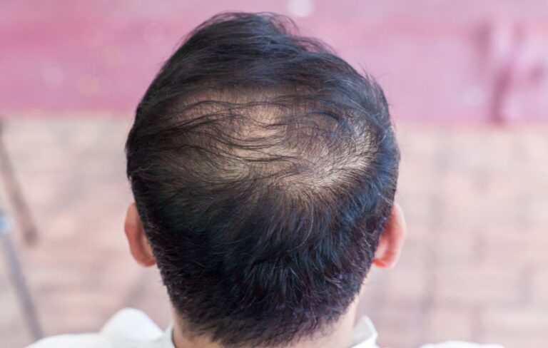 Como frenar la caida del cabello