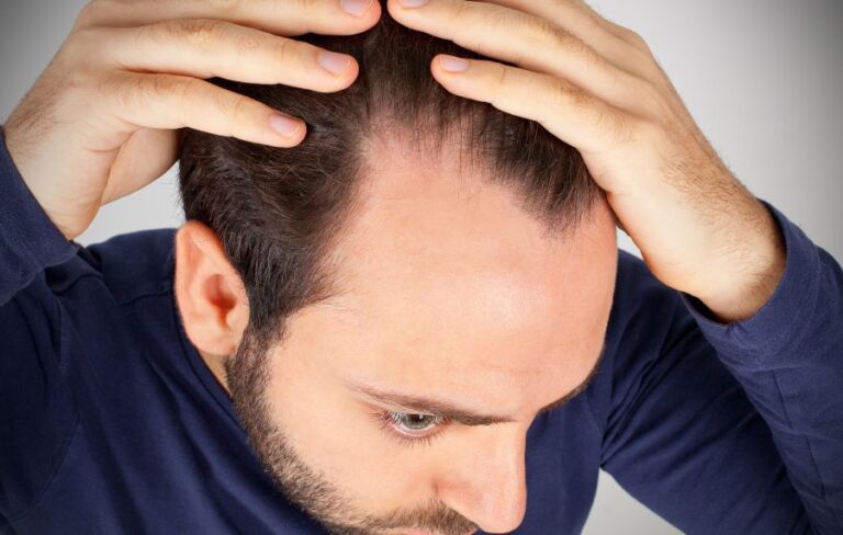 Como Detener Urgentemente la Caida del Cabello