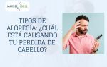Tipos de Alopecia Cuál está causando tu perdida de cabello