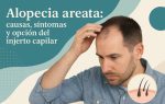 Alopecia areata: causas, síntomas y opción del injerto capilar 4 Imagen realista de un hombre con Alopecia Areata, ilustrando causas, síntomas y opción del injerto capilar, sobre fondo gráfico con formas vectoriales modernas.