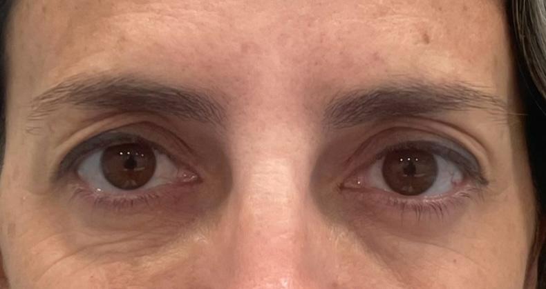 Blaferoplastia