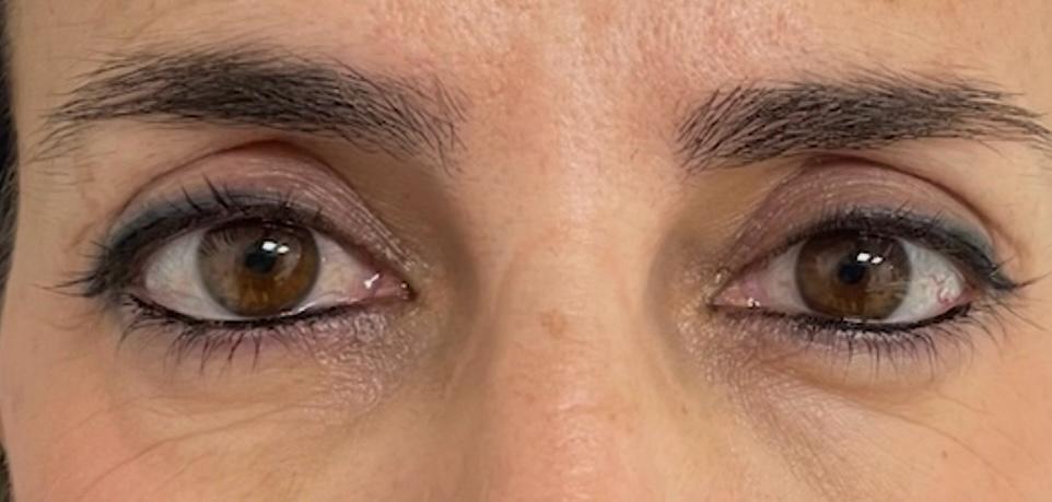 Blefaroplastia