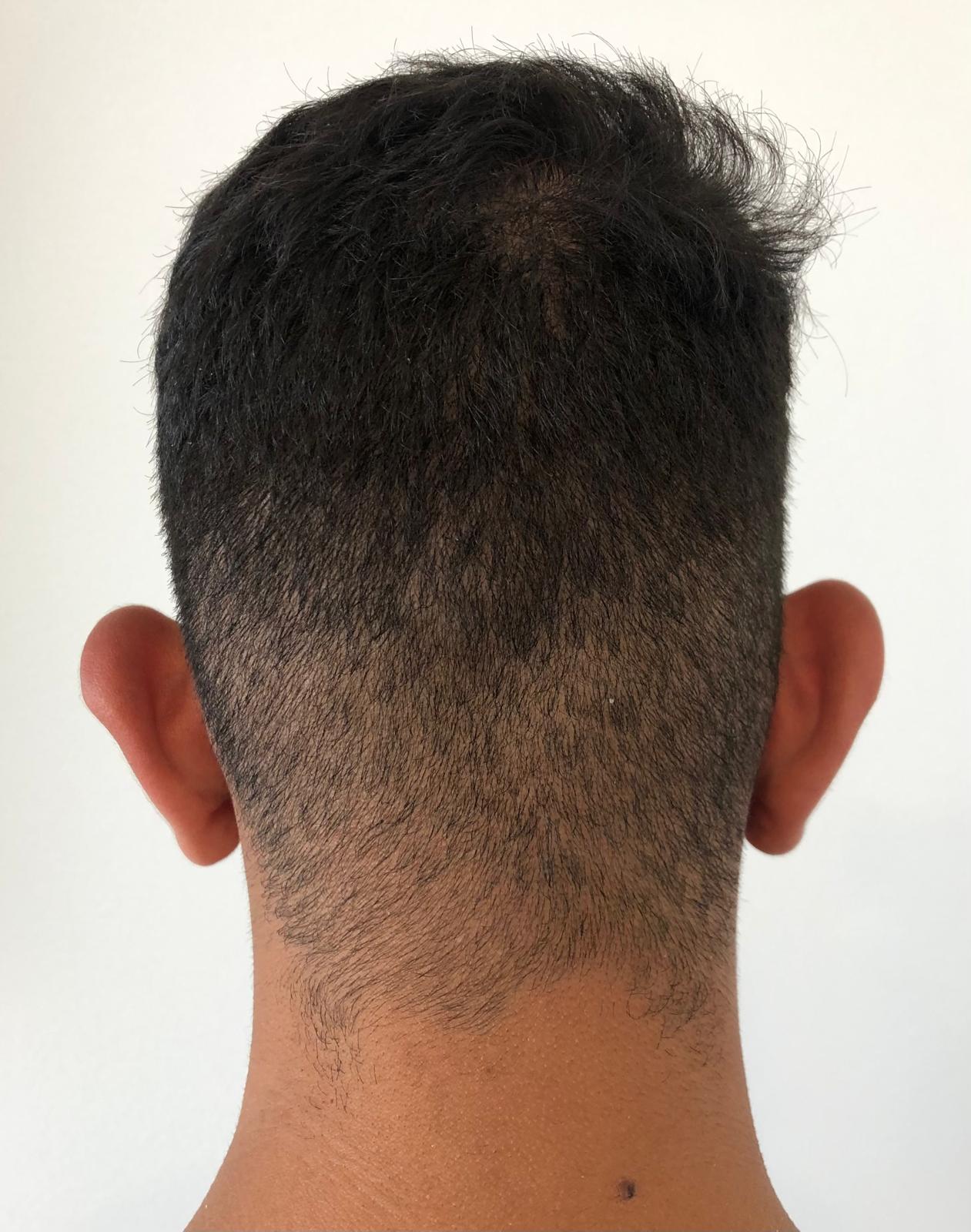 Antes Oreja Chico