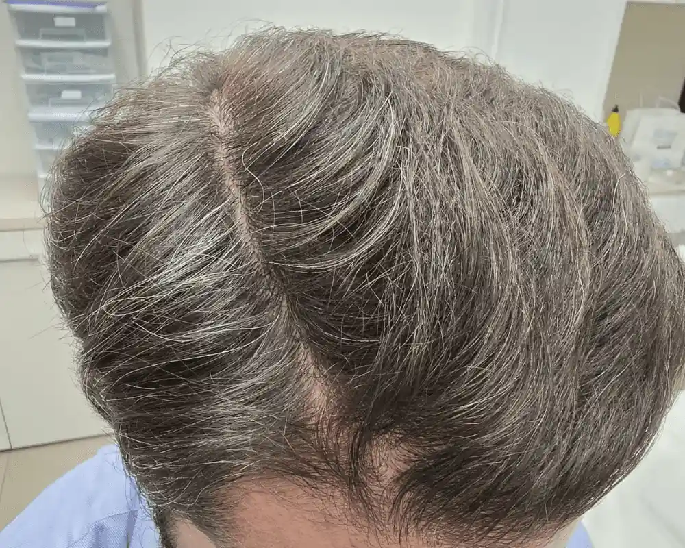 Mesoterapia antes